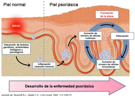 Que es útil la seta de té a la psoriasis